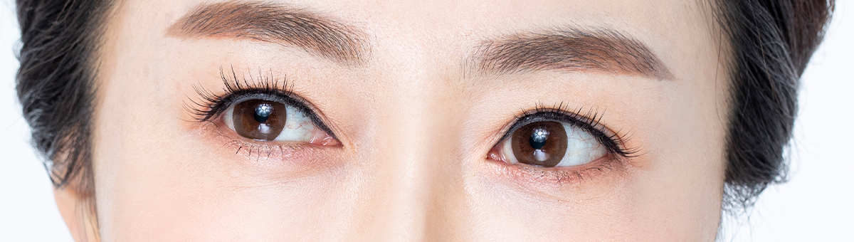 상안검 성형 이미지