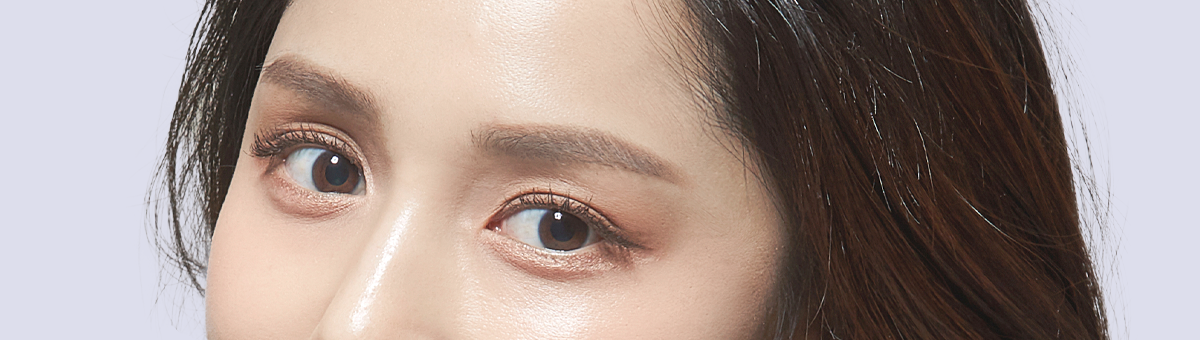 눈재수술 이미지